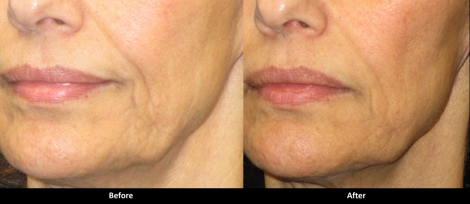 Laser Skin Tightening Med Spa In Encino CA A E Skin Professional