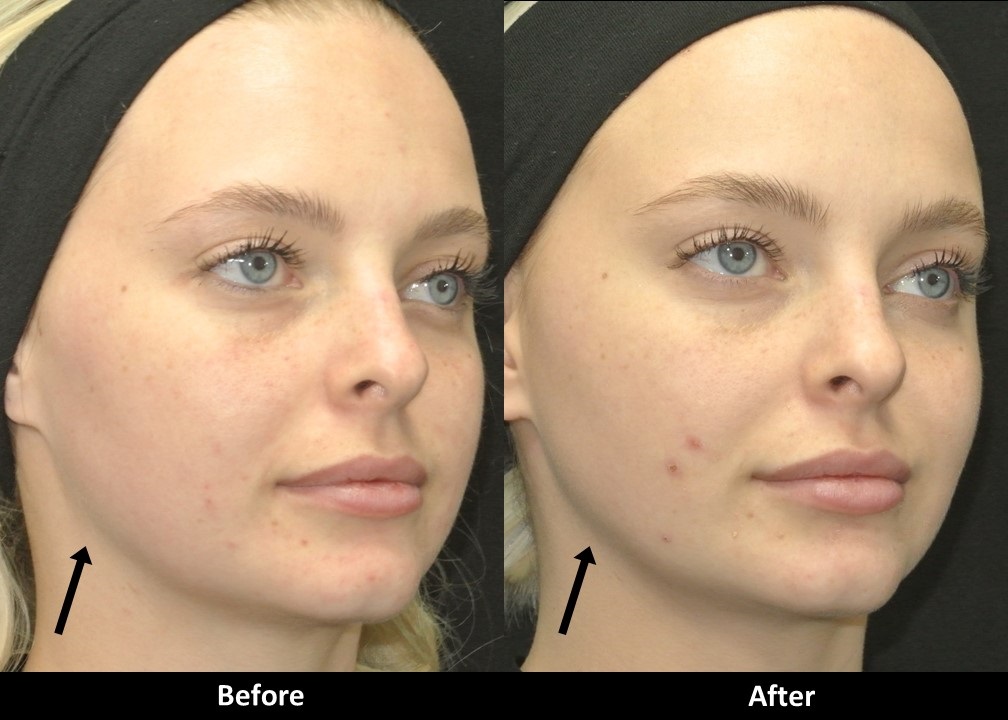 Voluma jawline before and after